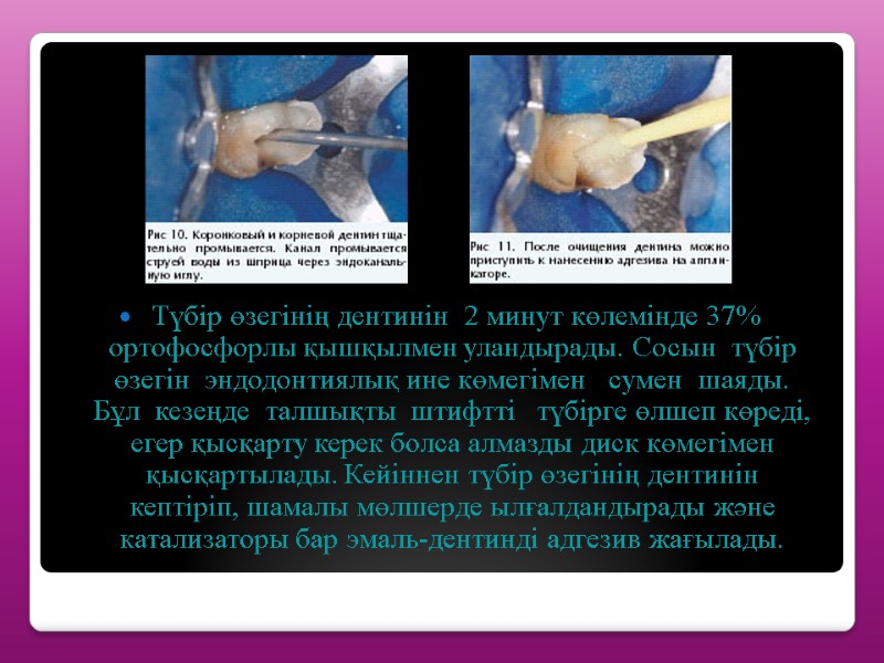 Түбір өзегінің дентинін  2 минут көлемінде 37%  ортофосфорлы қышқылмен уландырады. Сосын 